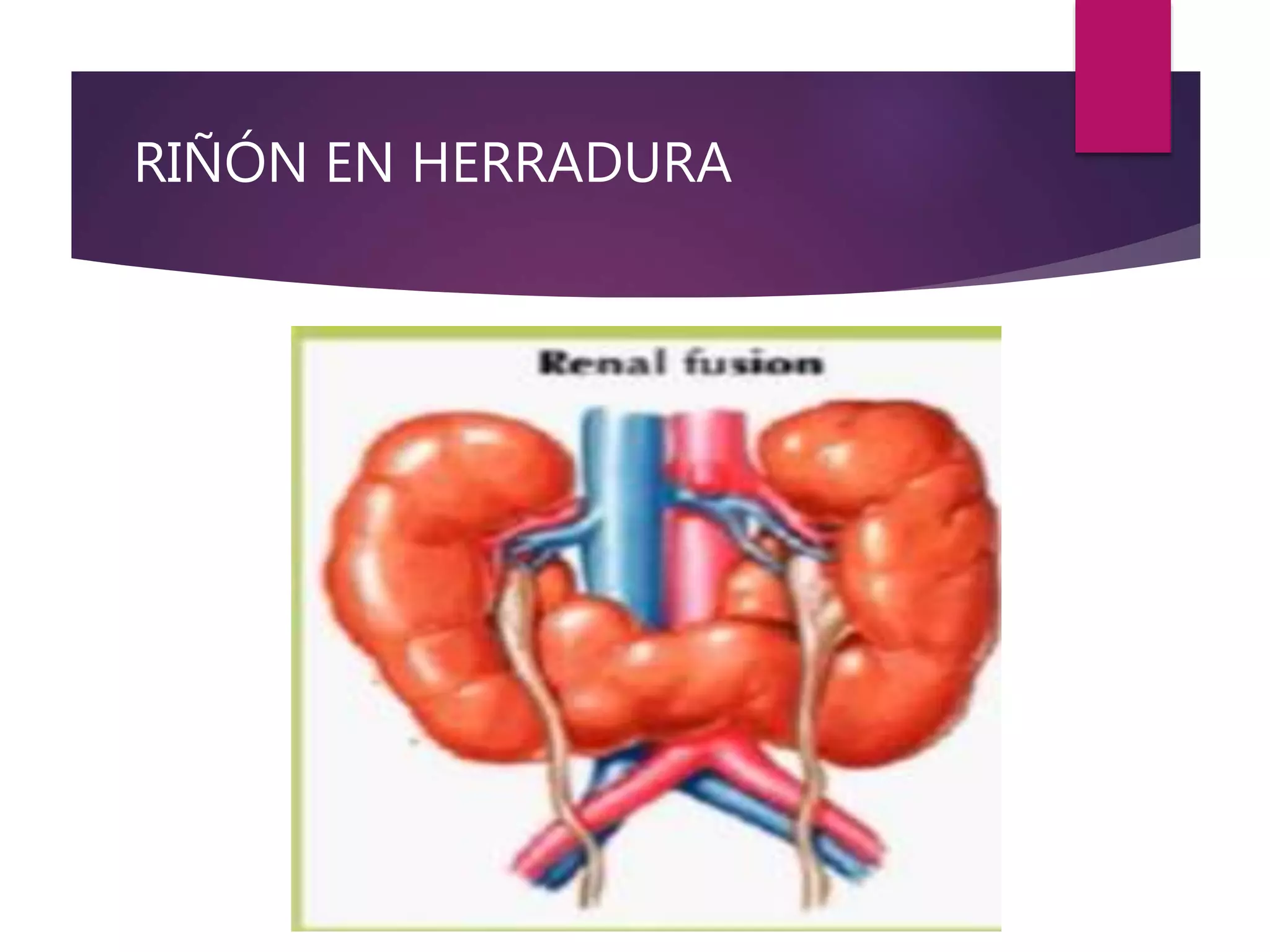 RIÑÓN EN HERRADURA
 