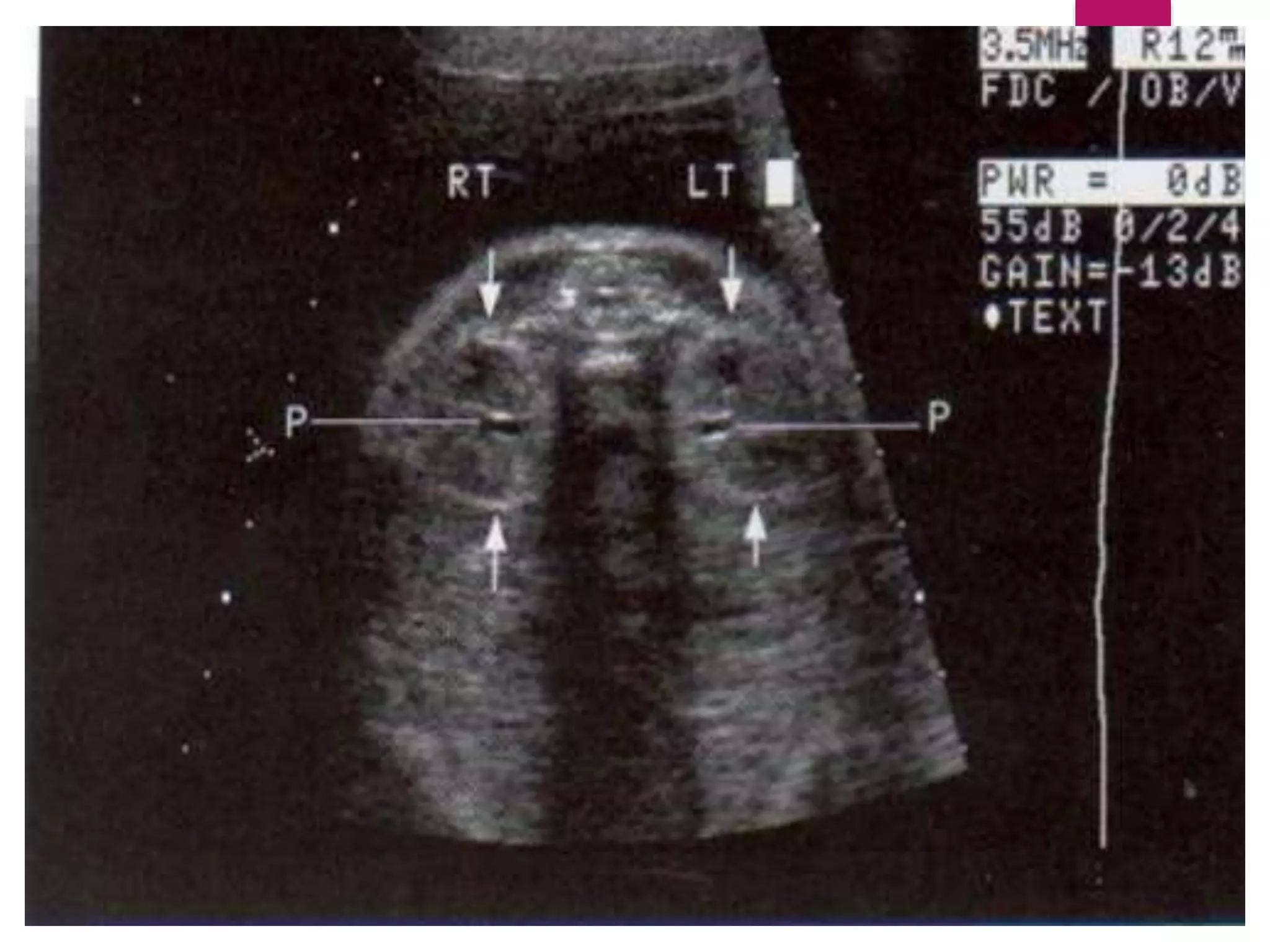 HIDRONEFROSIS PIELOCALIECTASIA
 