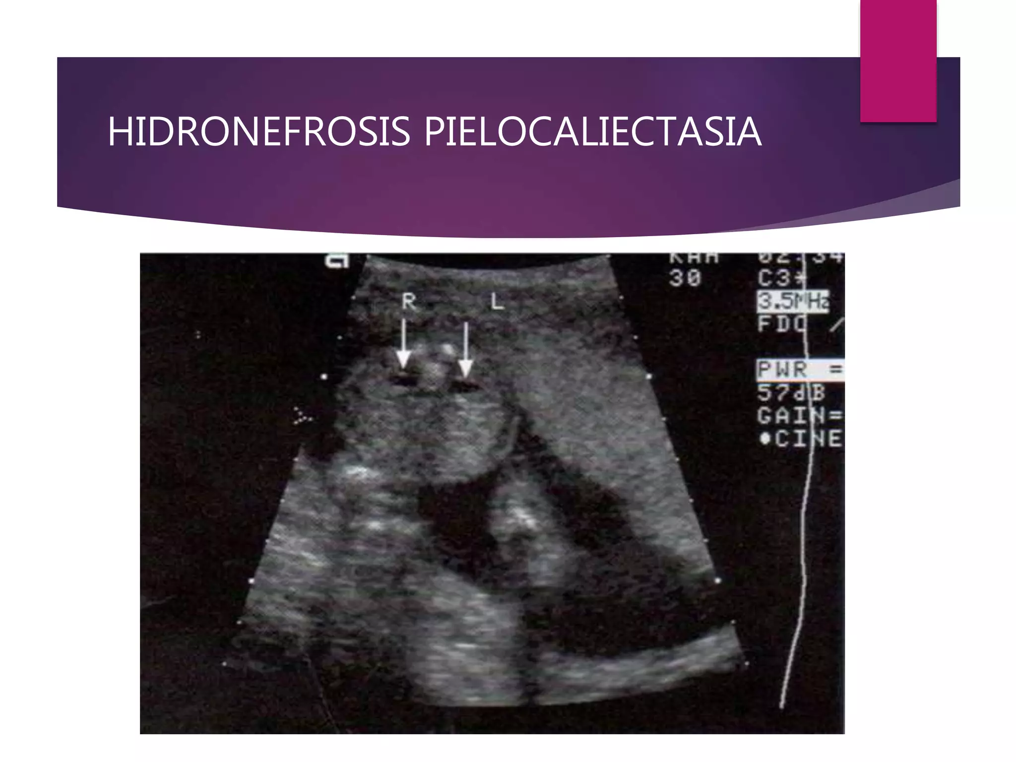 HIDRONEFROSIS PIELOCALIECTASIA
 