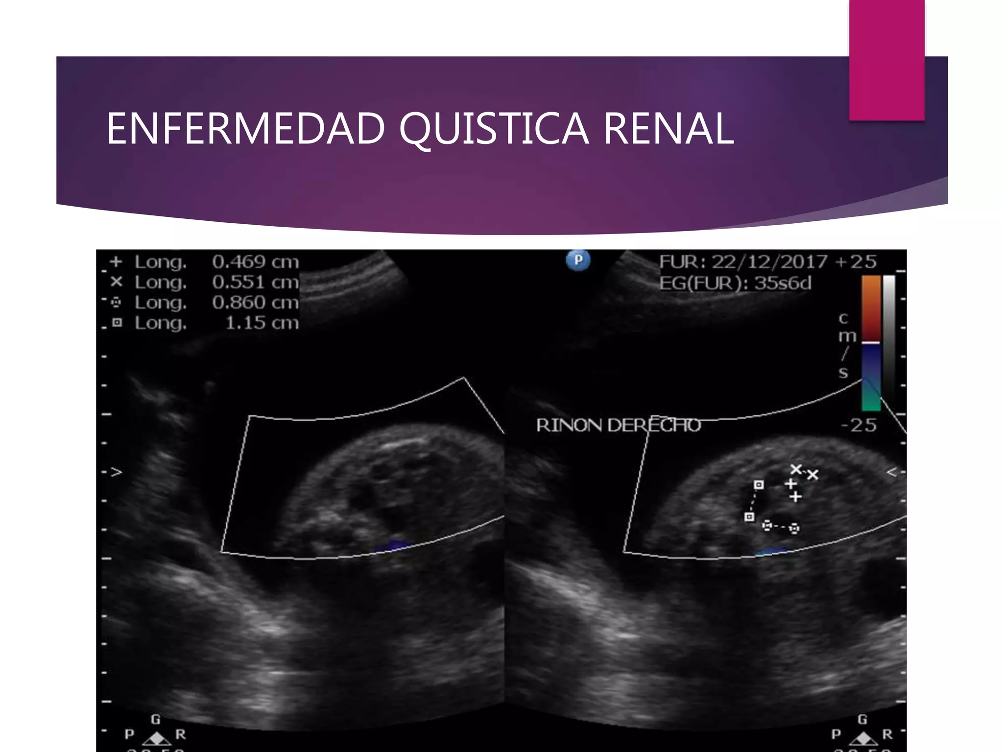 ENFERMEDAD QUISTICA RENAL
 