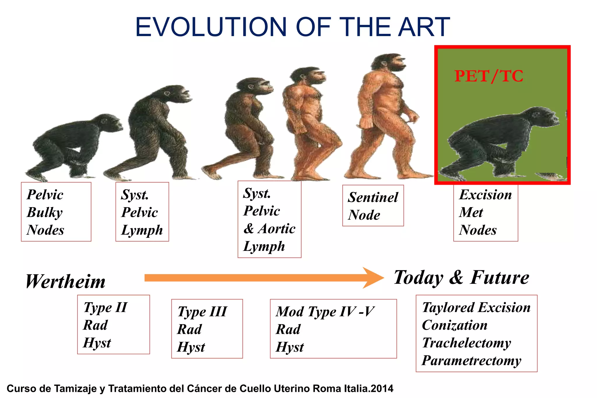 Wertheim
Pelvic
Bulky
Nodes
Type II
Rad
Hyst
Syst.
Pelvic
Lymph
Type III
Rad
Hyst
Syst.
Pelvic
& Aortic
Lymph
Mod Type IV -V
Rad
Hyst
Sentinel
Node
Taylored Excision
Conization
Trachelectomy
Parametrectomy
Excision
Met
Nodes
Today & Future
EVOLUTION OF THE ART
PET/TC
Curso de Tamizaje y Tratamiento del Cáncer de Cuello Uterino Roma Italia.2014
 