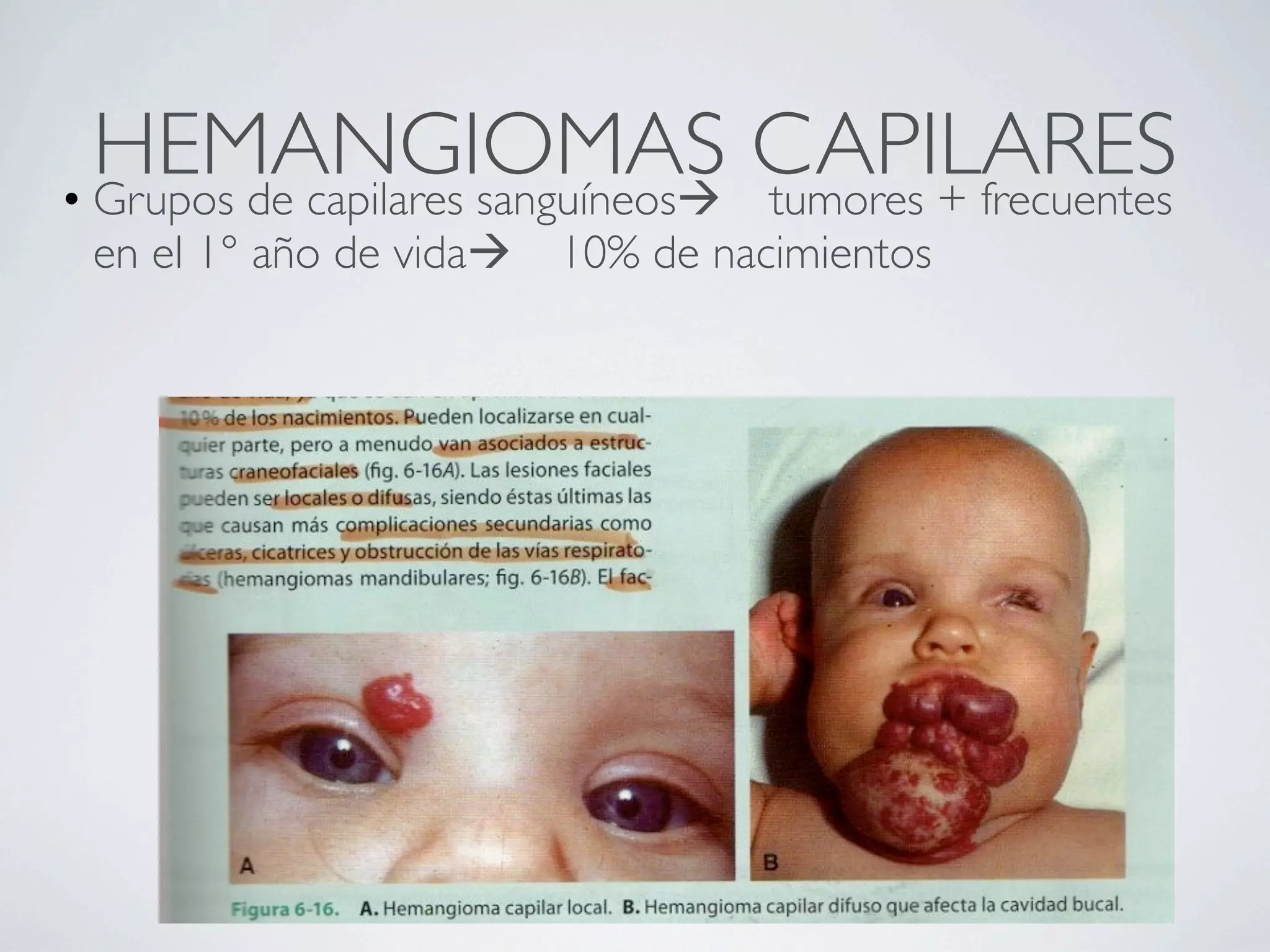 HEMANGIOMAS CAPILARES
• Grupos de capilares sanguíneos tumores + frecuentes
 en el 1° año de vida   10% de nacimientos
 