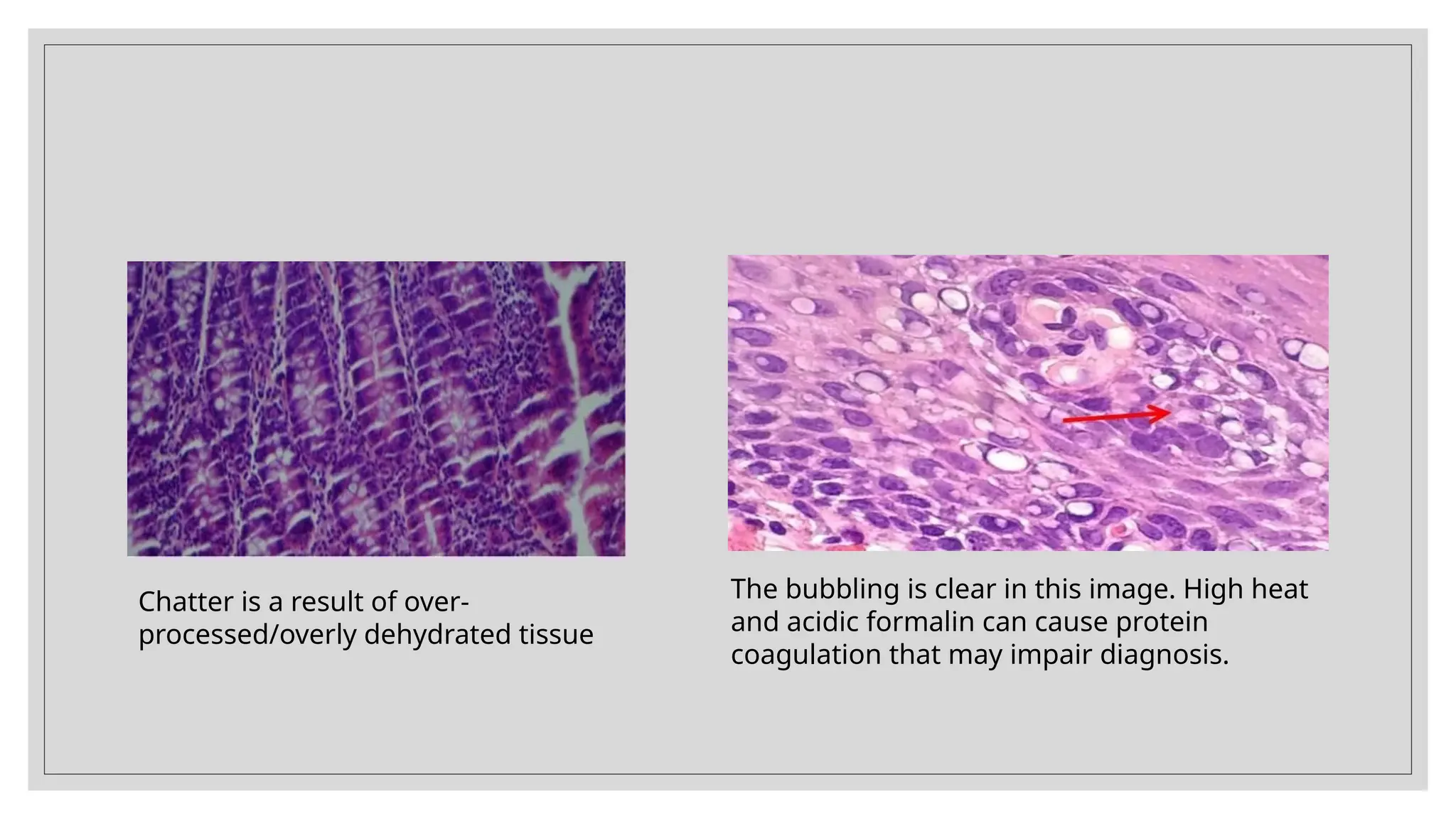 Chatter is a result of over-
processed/overly dehydrated tissue
The bubbling is clear in this image. High heat
and acidic formalin can cause protein
coagulation that may impair diagnosis.
 