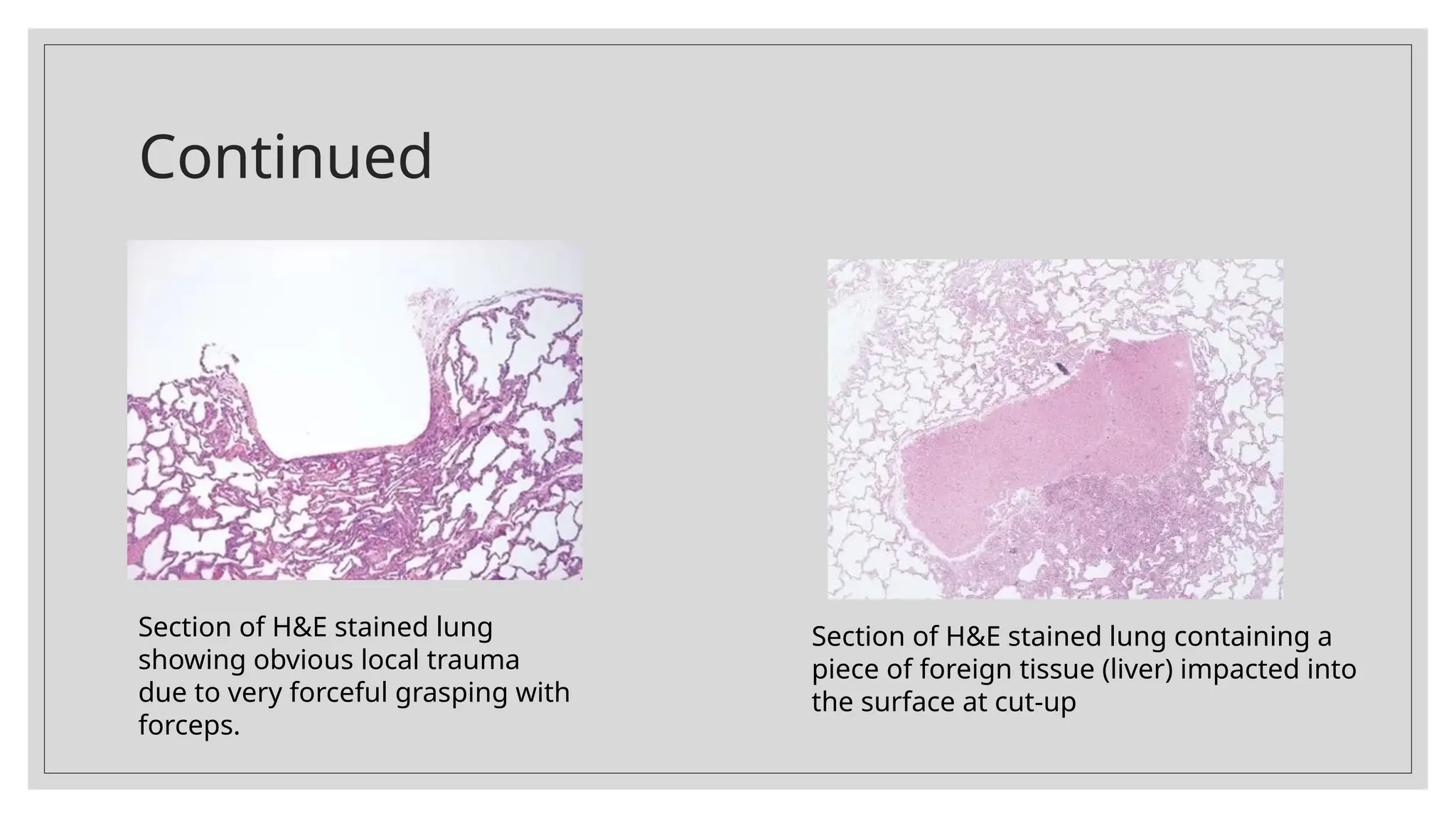 Continued
Section of H&E stained lung
showing obvious local trauma
due to very forceful grasping with
forceps.
Section of H&E stained lung containing a
piece of foreign tissue (liver) impacted into
the surface at cut-up
 