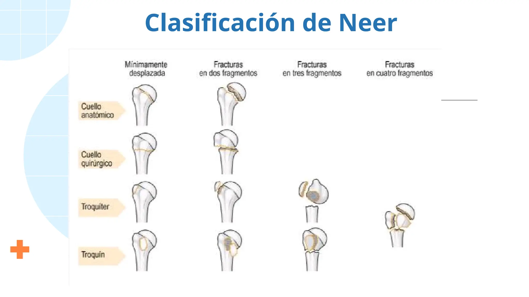 Clasificación de Neer
 