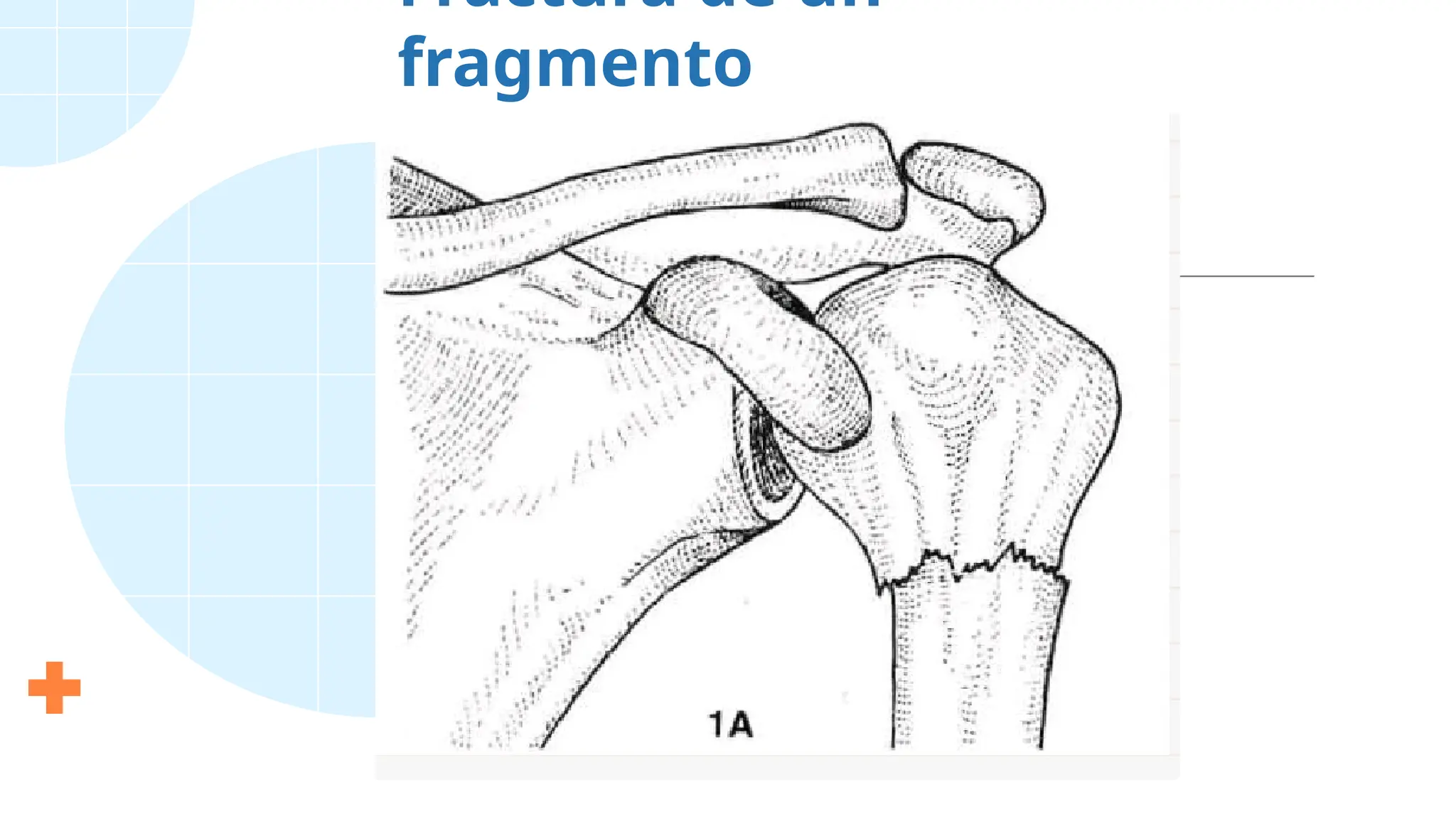 Fractura de un
fragmento
 