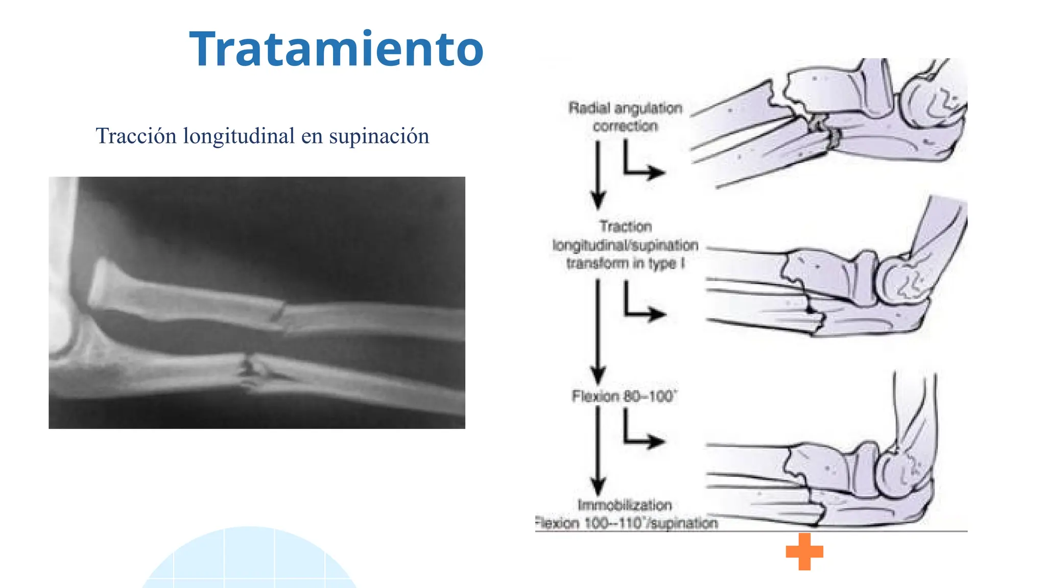 Tratamiento
Tracción longitudinal en supinación
 