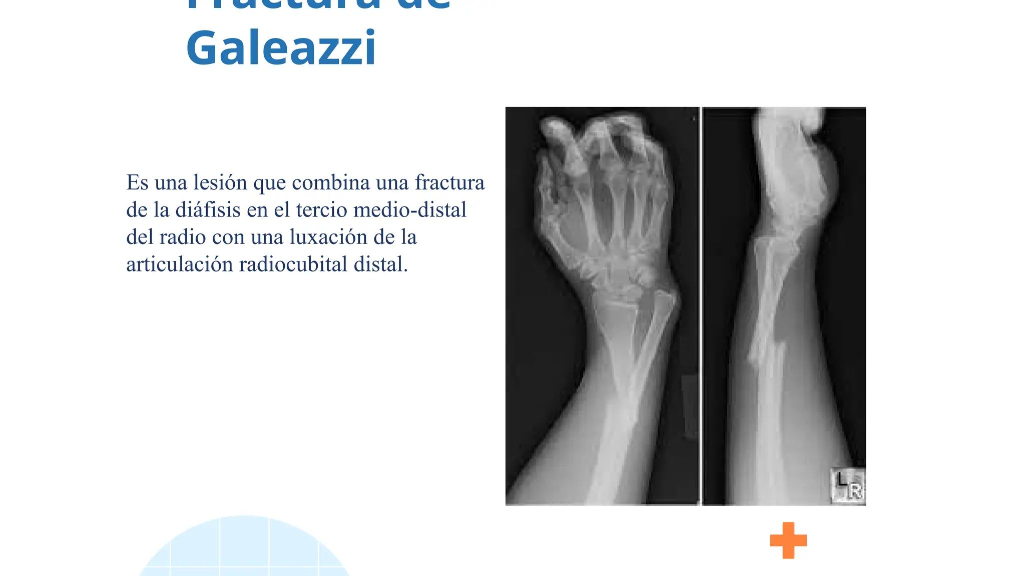 Fractura de
Galeazzi
Es una lesión que combina una fractura
de la diáfisis en el tercio medio-distal
del radio con una luxación de la
articulación radiocubital distal.
 