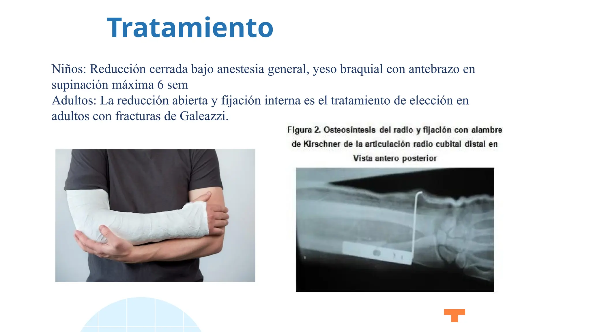Tratamiento
Niños: Reducción cerrada bajo anestesia general, yeso braquial con antebrazo en
supinación máxima 6 sem
Adultos: La reducción abierta y fijación interna es el tratamiento de elección en
adultos con fracturas de Galeazzi.
 