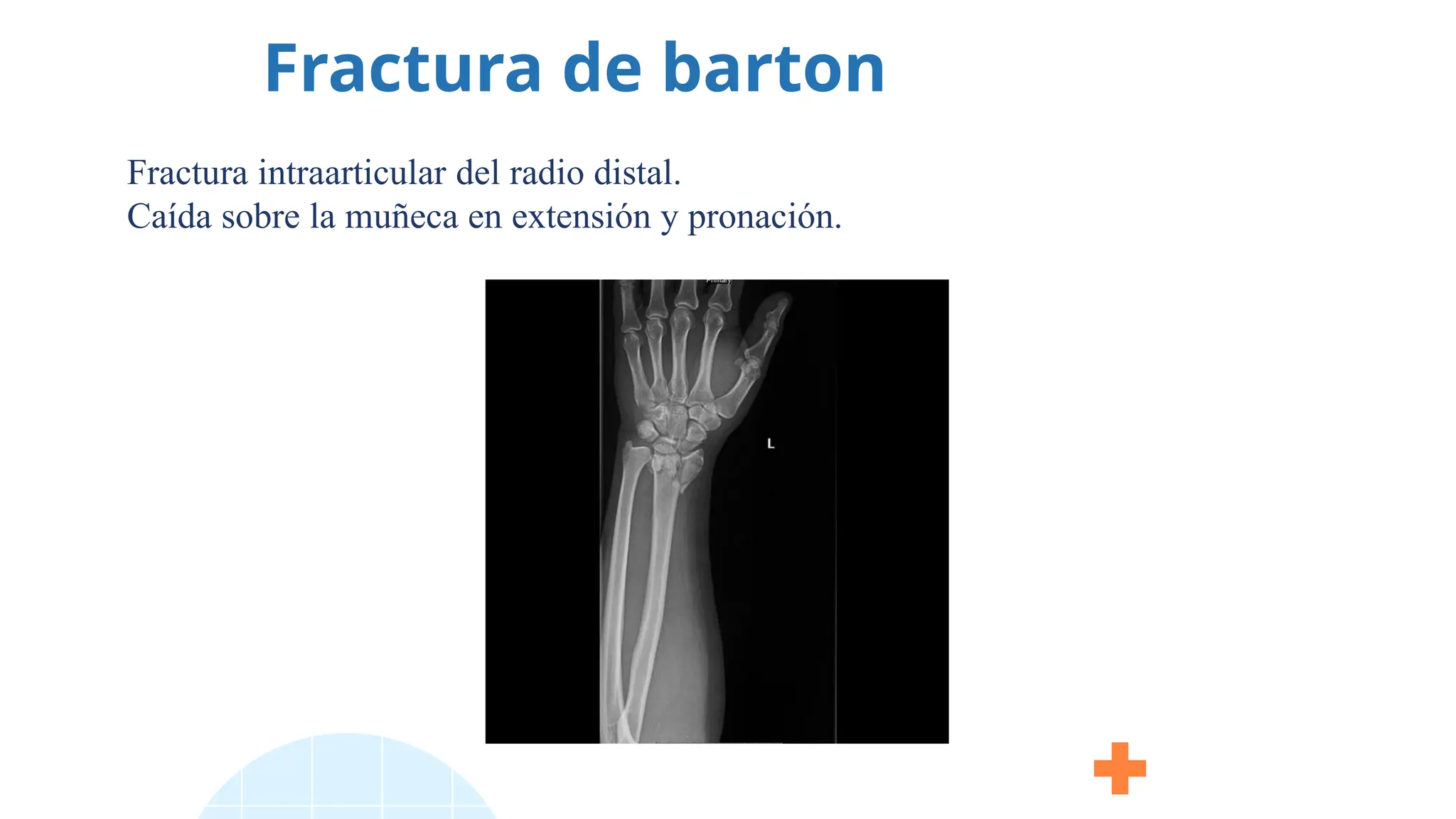 Fractura de barton
Fractura intraarticular del radio distal.
Caída sobre la muñeca en extensión y pronación.
 