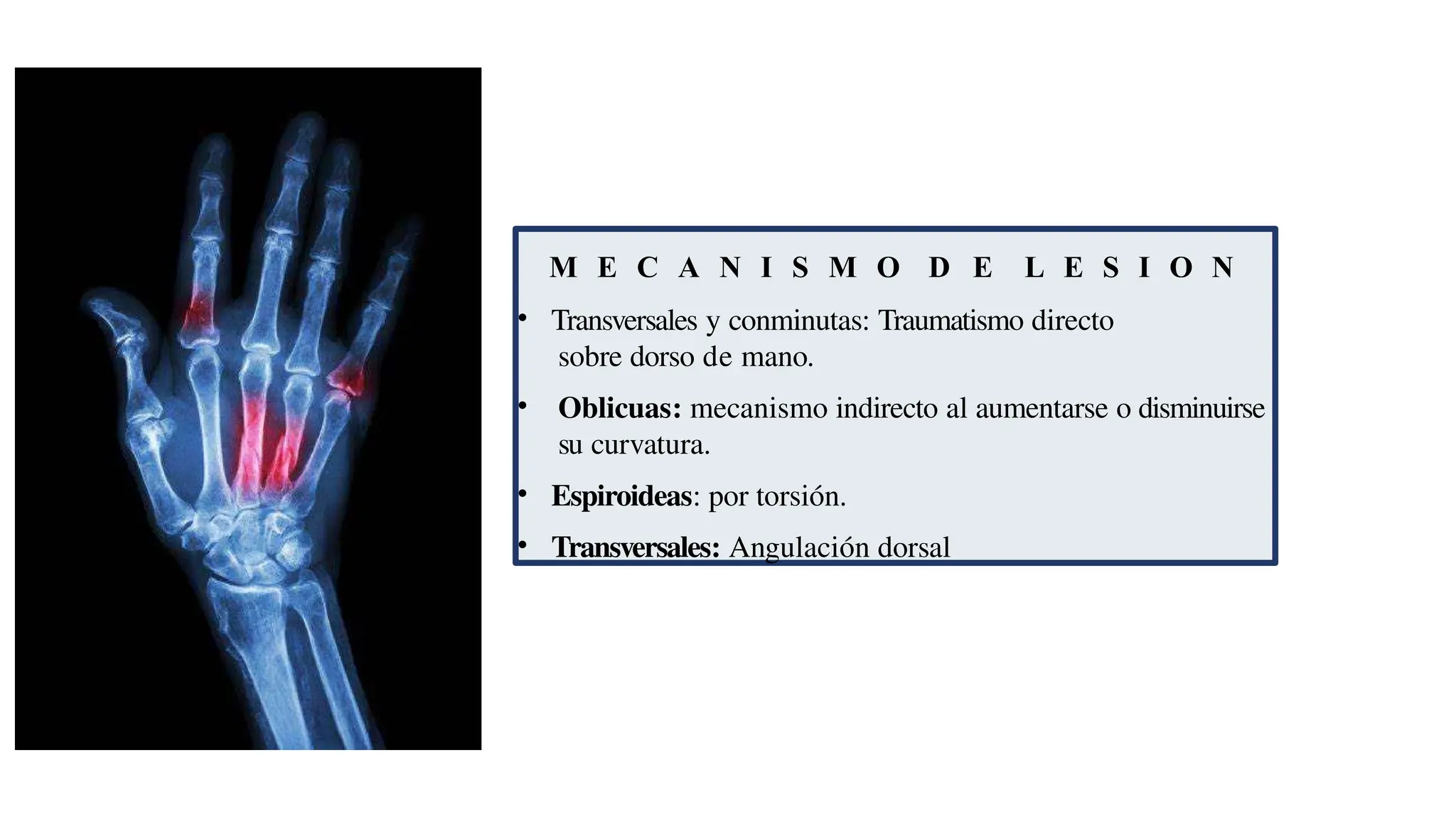 M E C A N I S M O D E L E S I O N
• Transversales y conminutas: Traumatismo directo
sobre dorso de mano.
• Oblicuas: mecanismo indirecto al aumentarse o disminuirse
su curvatura.
• Espiroideas: por torsión.
• Transversales: Angulación dorsal
 