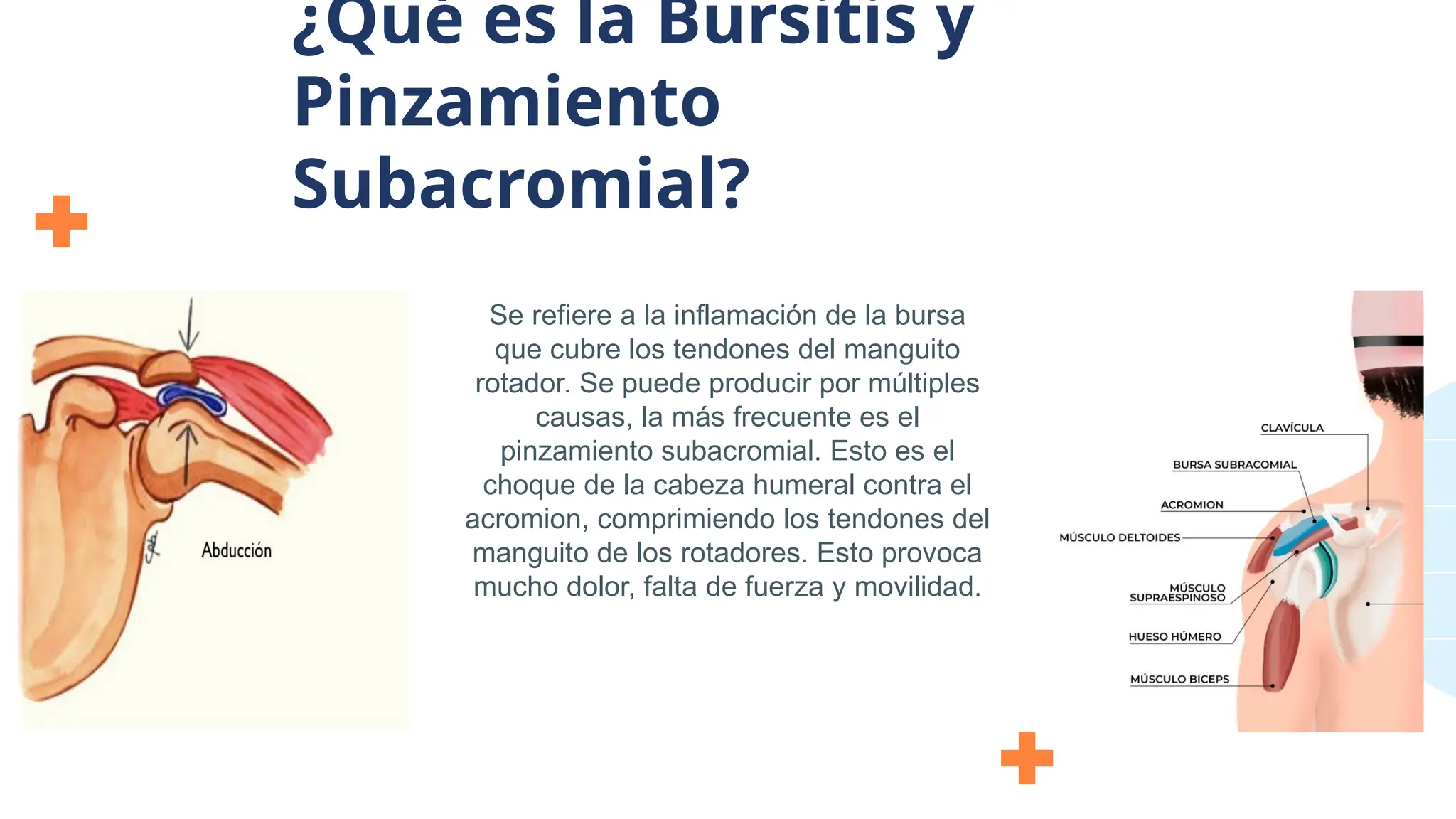 Se refiere a la inflamación de la bursa
que cubre los tendones del manguito
rotador. Se puede producir por múltiples
causas, la más frecuente es el
pinzamiento subacromial. Esto es el
choque de la cabeza humeral contra el
acromion, comprimiendo los tendones del
manguito de los rotadores. Esto provoca
mucho dolor, falta de fuerza y movilidad.
¿Qué es la Bursitis y
Pinzamiento
Subacromial?
 
