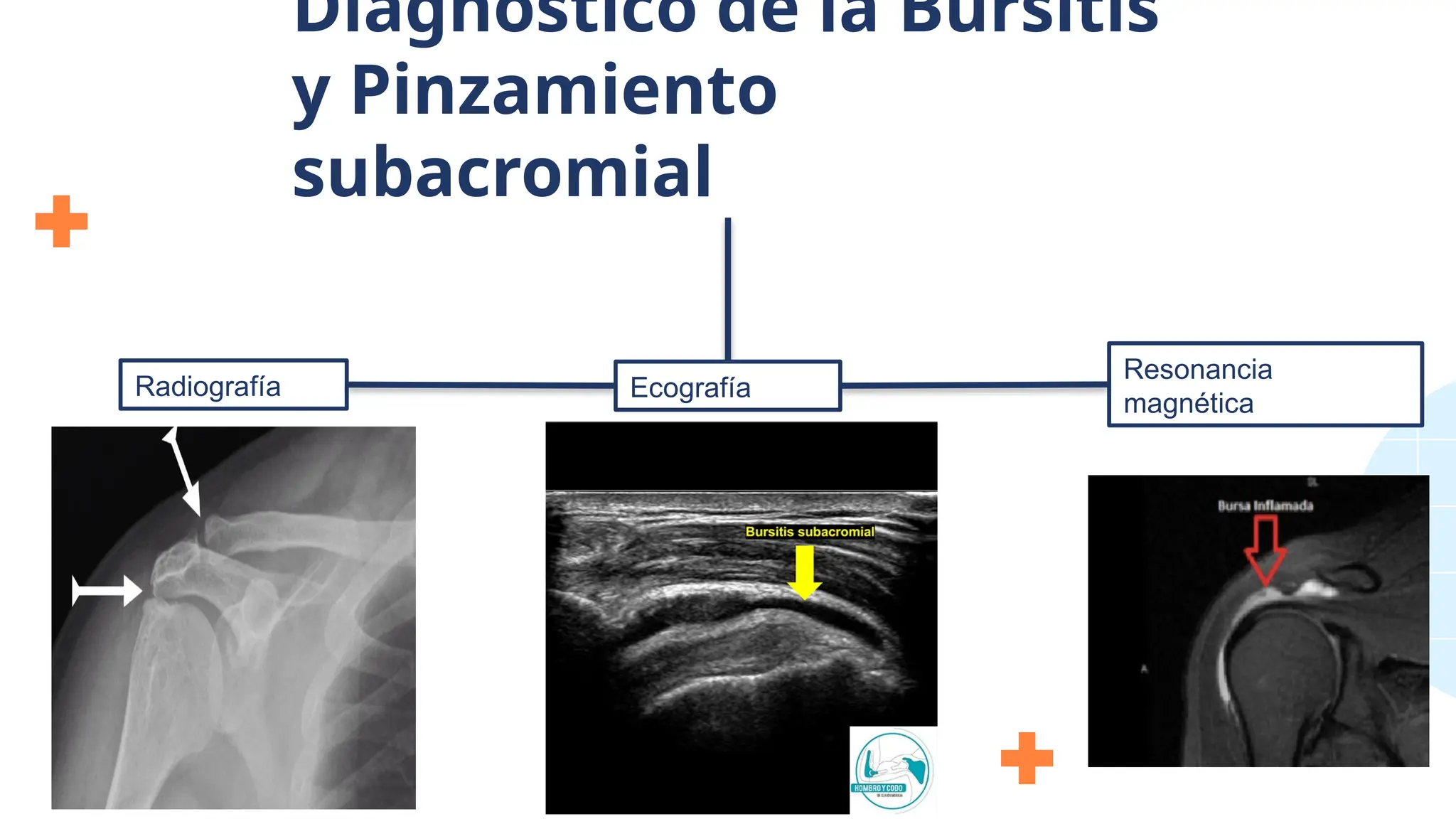 Diagnóstico de la Bursitis
y Pinzamiento
subacromial
Radiografía Ecografía
Resonancia
magnética
 
