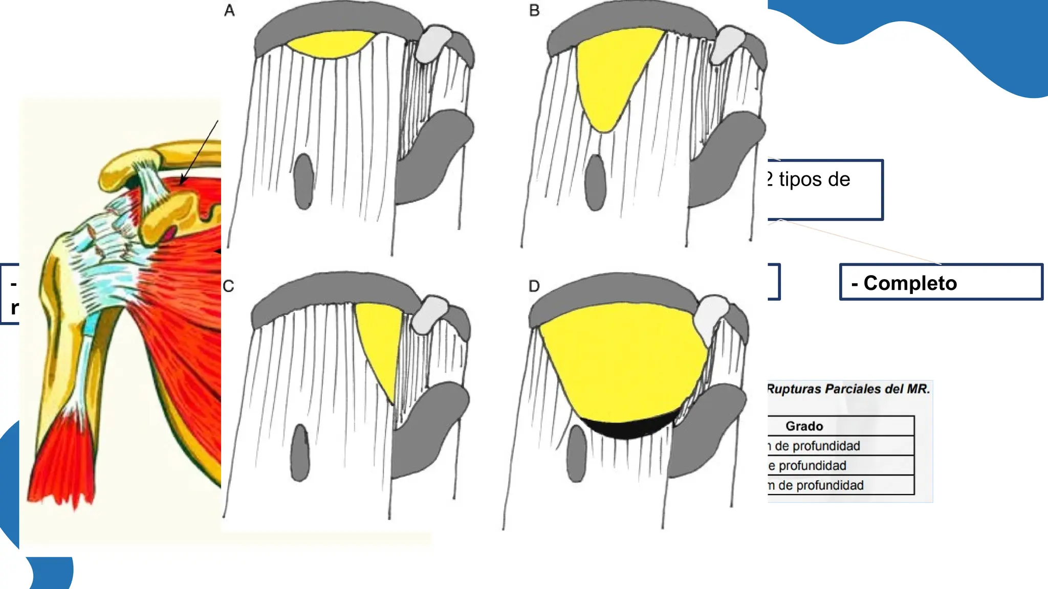 Desgarros
- Un desgarro
repentino o agudo
- Un desgarro
crónico
Pueden ocurrir de 2
maneras
Existen 2 tipos de
rupturas
- Parcial - Completo
 