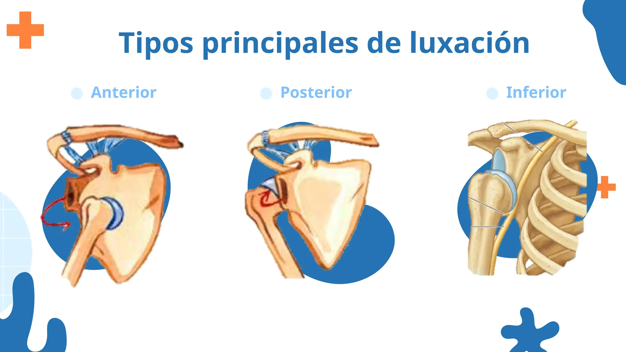 Tipos principales de luxación
● Anterior ● Posterior ● Inferior
 