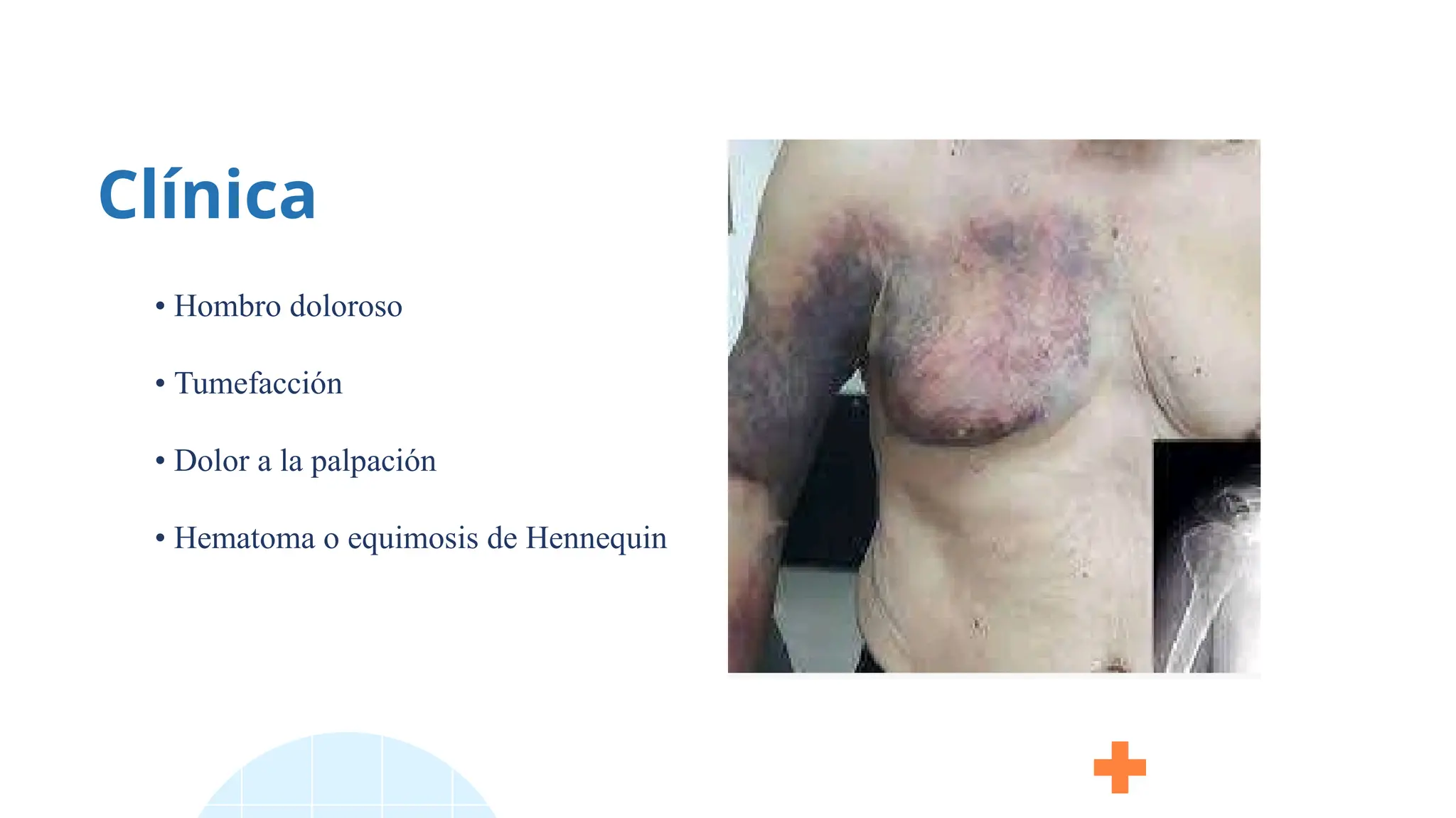 Clínica
• Hombro doloroso
• Tumefacción
• Dolor a la palpación
• Hematoma o equimosis de Hennequin
 