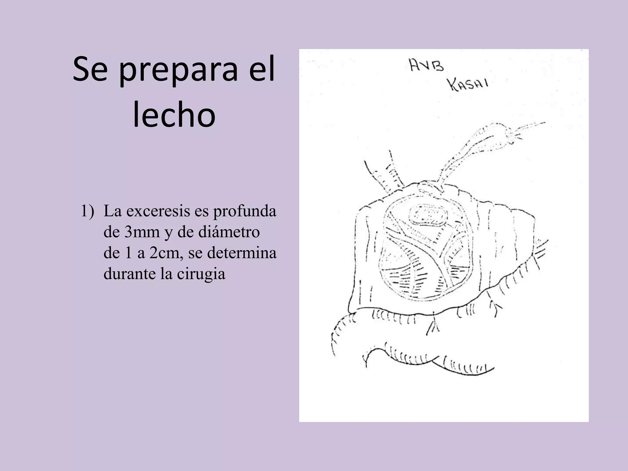 Se prepara el
lecho
1) La exceresis es profunda
de 3mm y de diámetro
de 1 a 2cm, se determina
durante la cirugia
 