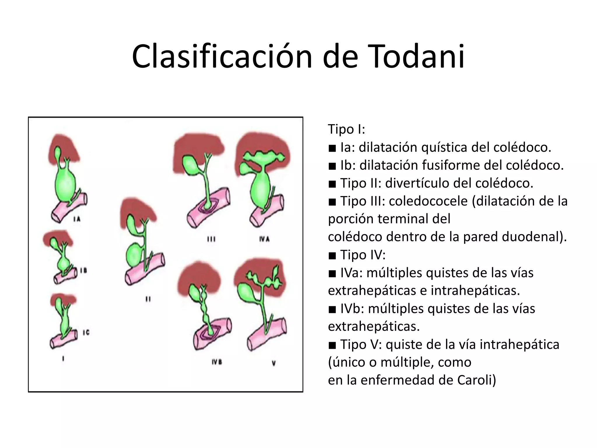 Clasificación de Todani
Tipo I:
■ Ia: dilatación quística del colédoco.
■ Ib: dilatación fusiforme del colédoco.
■ Tipo II: divertículo del colédoco.
■ Tipo III: coledococele (dilatación de la
porción terminal del
colédoco dentro de la pared duodenal).
■ Tipo IV:
■ IVa: múltiples quistes de las vías
extrahepáticas e intrahepáticas.
■ IVb: múltiples quistes de las vías
extrahepáticas.
■ Tipo V: quiste de la vía intrahepática
(único o múltiple, como
en la enfermedad de Caroli)
 