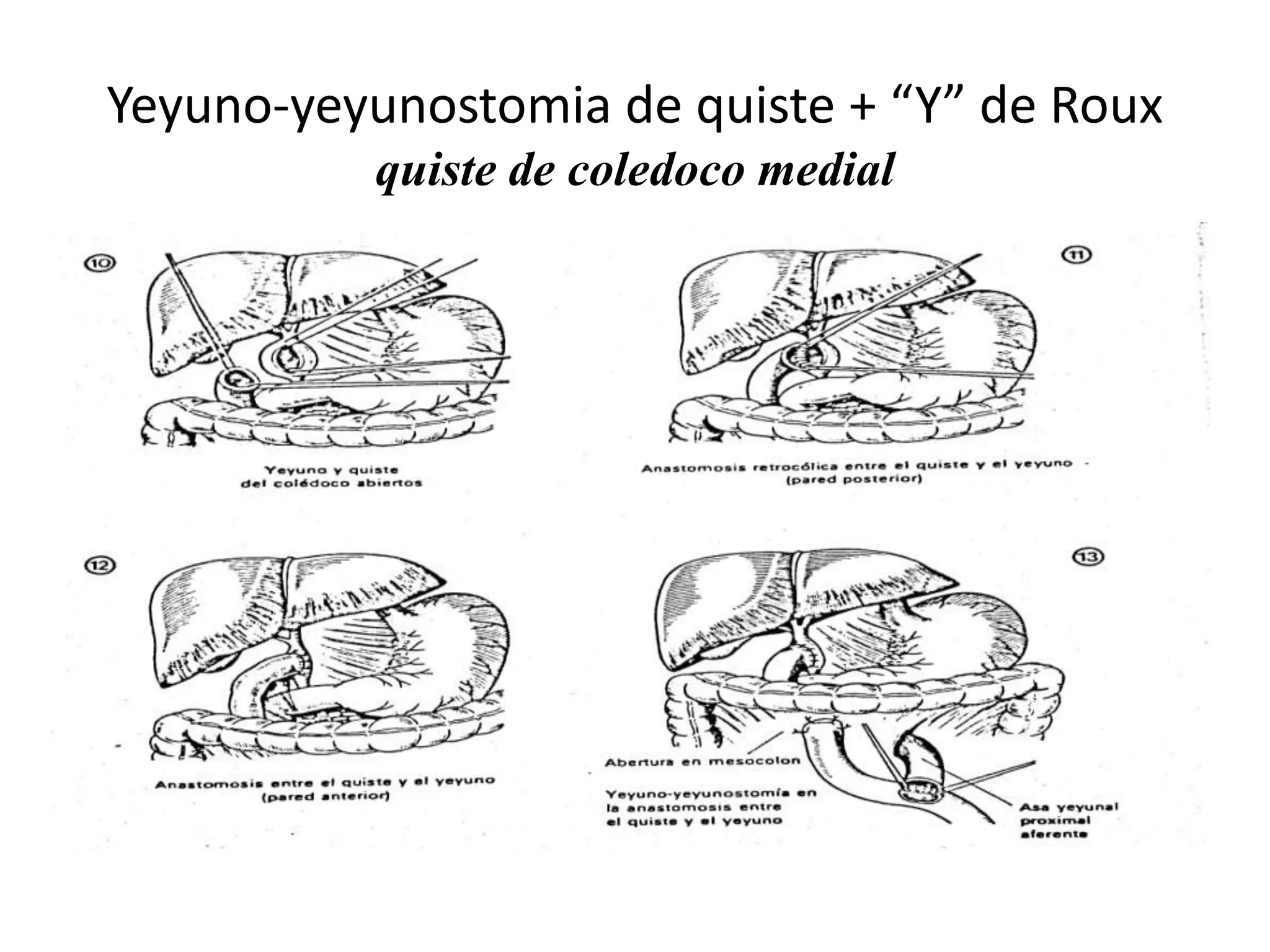 Yeyuno-yeyunostomia de quiste + “Y” de Roux
quiste de coledoco medial
 