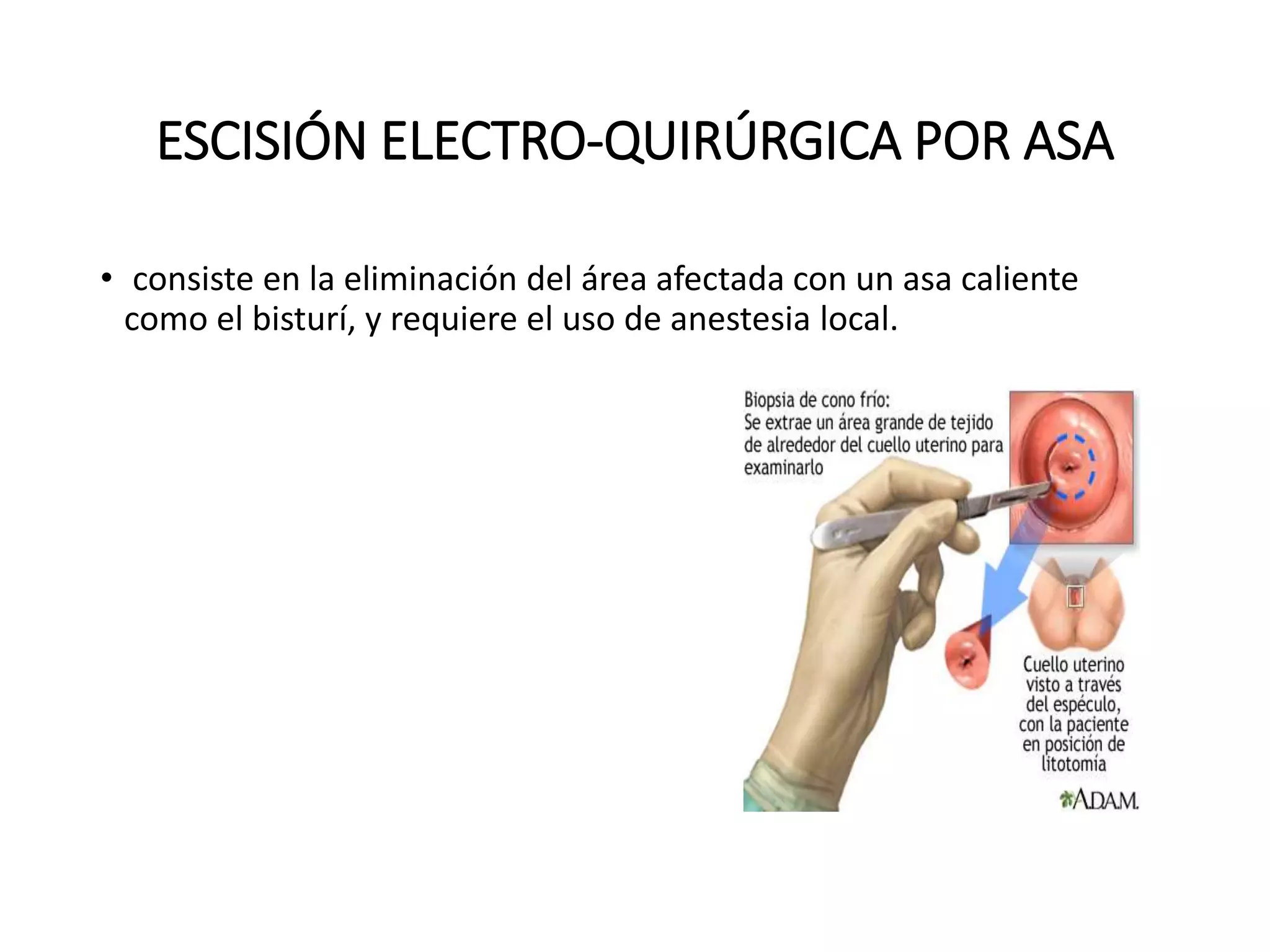 ESCISIÓN ELECTRO-QUIRÚRGICA POR ASA
• consiste en la eliminación del área afectada con un asa caliente
como el bisturí, y requiere el uso de anestesia local.
 