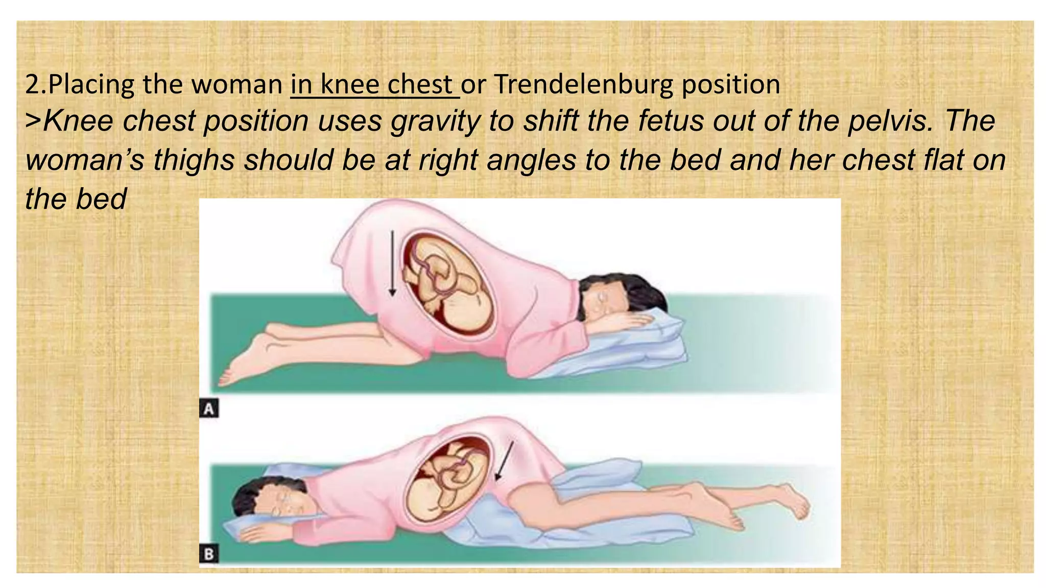2.Placing the woman in knee chest or Trendelenburg position
>Knee chest position uses gravity to shift the fetus out of the pelvis. The
woman’s thighs should be at right angles to the bed and her chest flat on
the bed
 