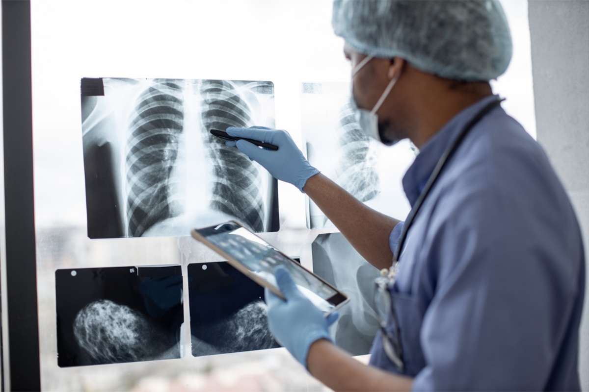 Le cancer du poumon est le deuxième cancer chez l’homme et chez la femme, depuis 2018.